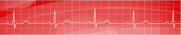 Figure 2.&nbsp;Sinus Bradycardia. Presented at a rate of approximately 50 beats per minute. Note the normal sinus rhythm presentation, but at an abnormally lower rate resulting in a slower production of deflections. 