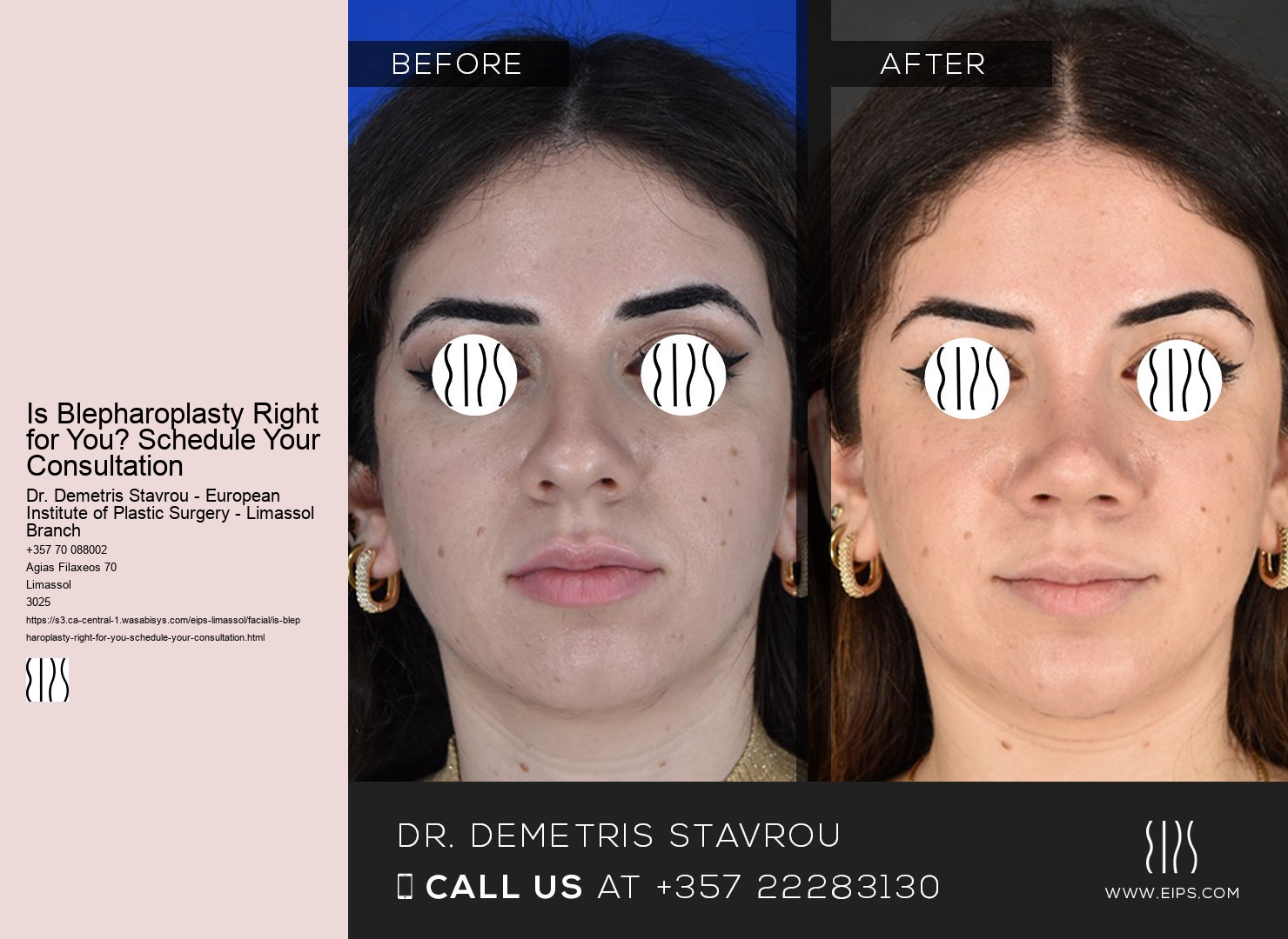 Is Blepharoplasty Right for You? Schedule Your Consultation