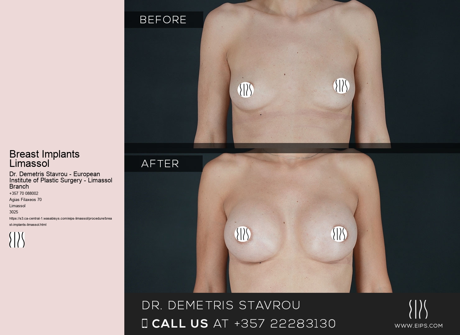Breast Implants Limassol